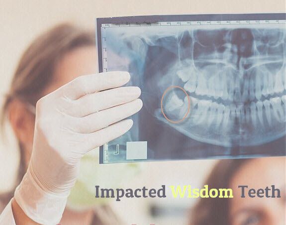 impacted wisdom tooth pain