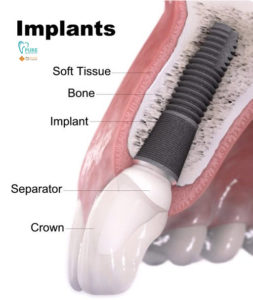 implant placement procedure