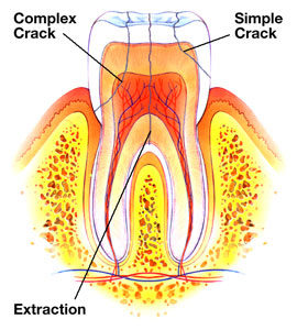 simple and complex cracks in tooth