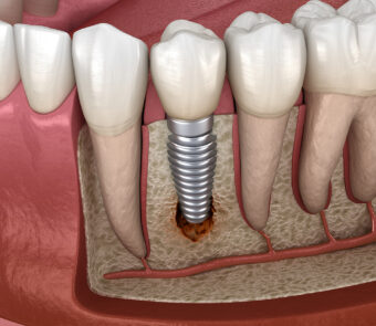 Complications Of Dental Implants In Brisbane