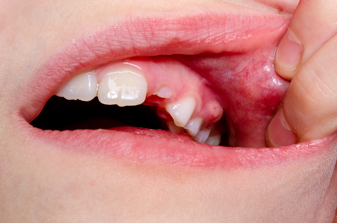 how to drain a tooth abscess