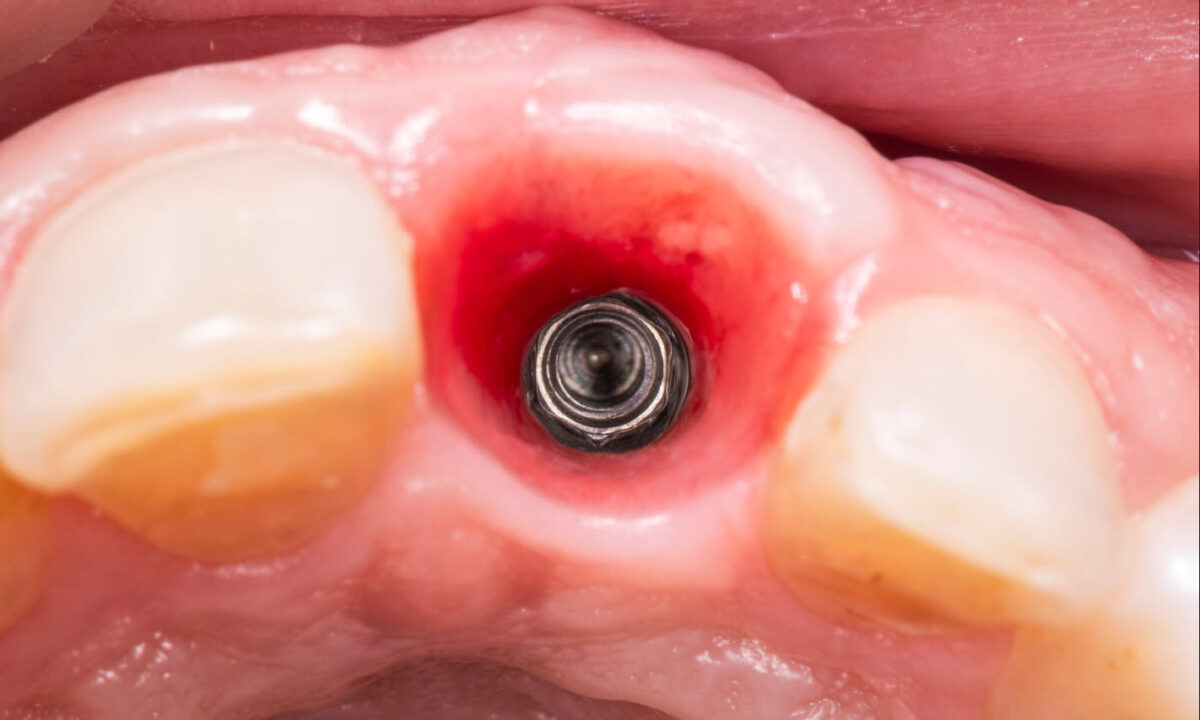 Dental Implants in Brisbane