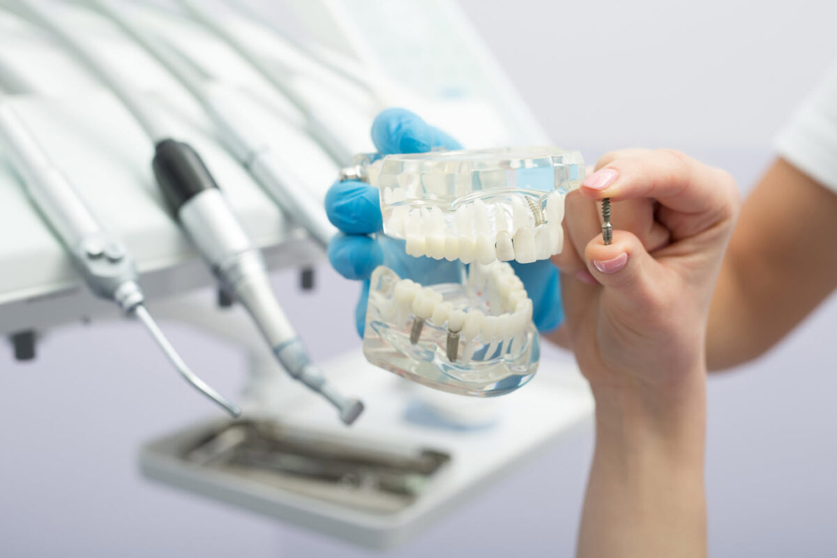 Tooth Implant Brisbane