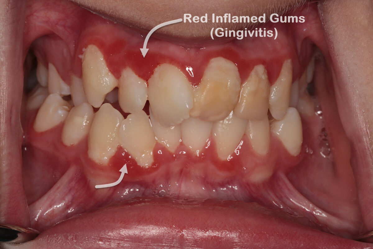 Gingivitis treatment