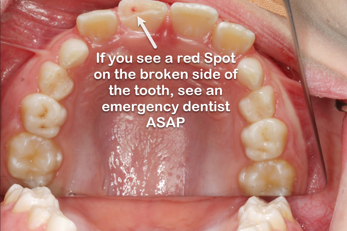 Emergency Dentist for broken tooth