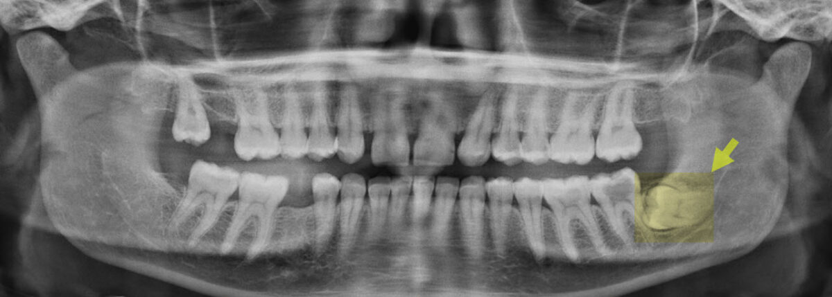 Impacted third molar extraction