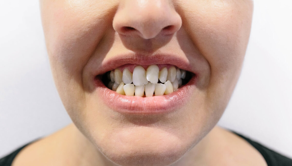 Crooked Teeth Best Treatment