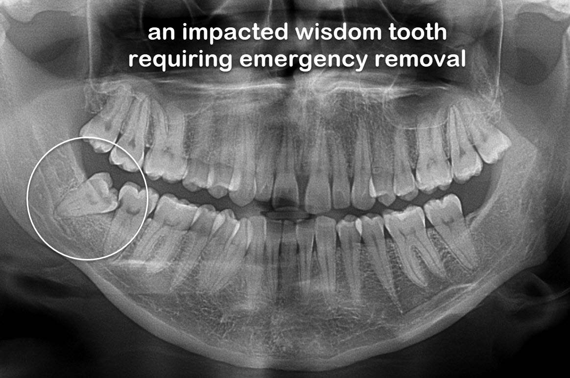Brisbane emergency dentist open 24/7 for wisdom tooth