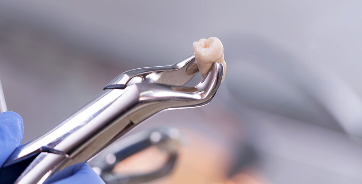afterpay tooth extraction