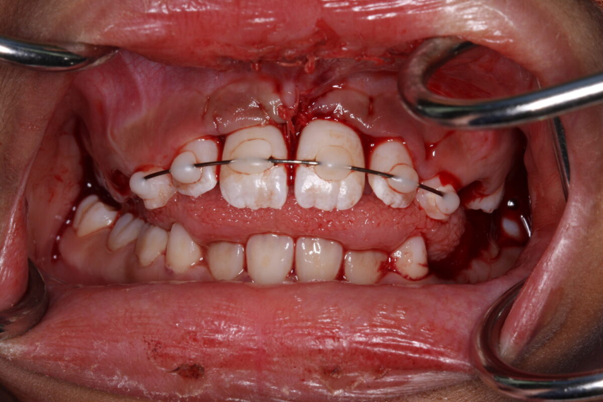 Loose teeth splint