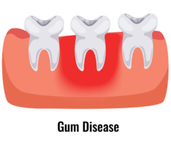 inflammation of your gums